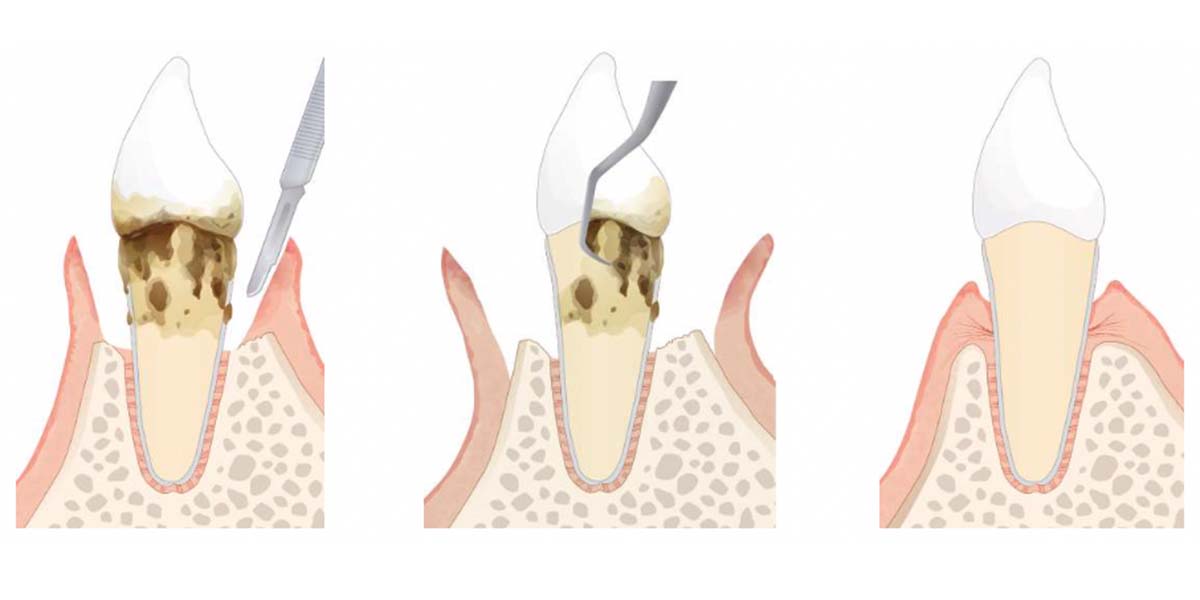 歯周外科治療