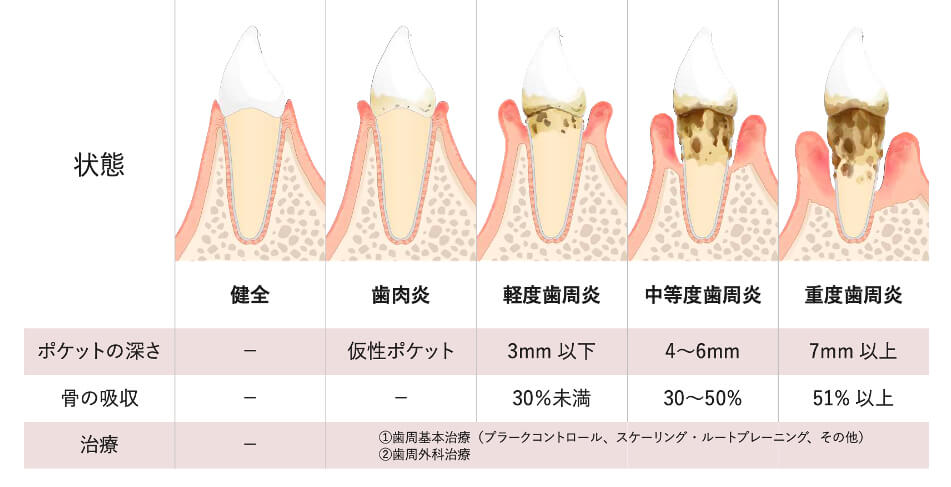 歯周病の進行