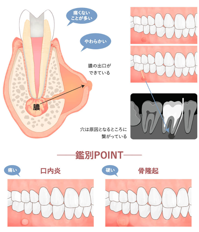 根管治療